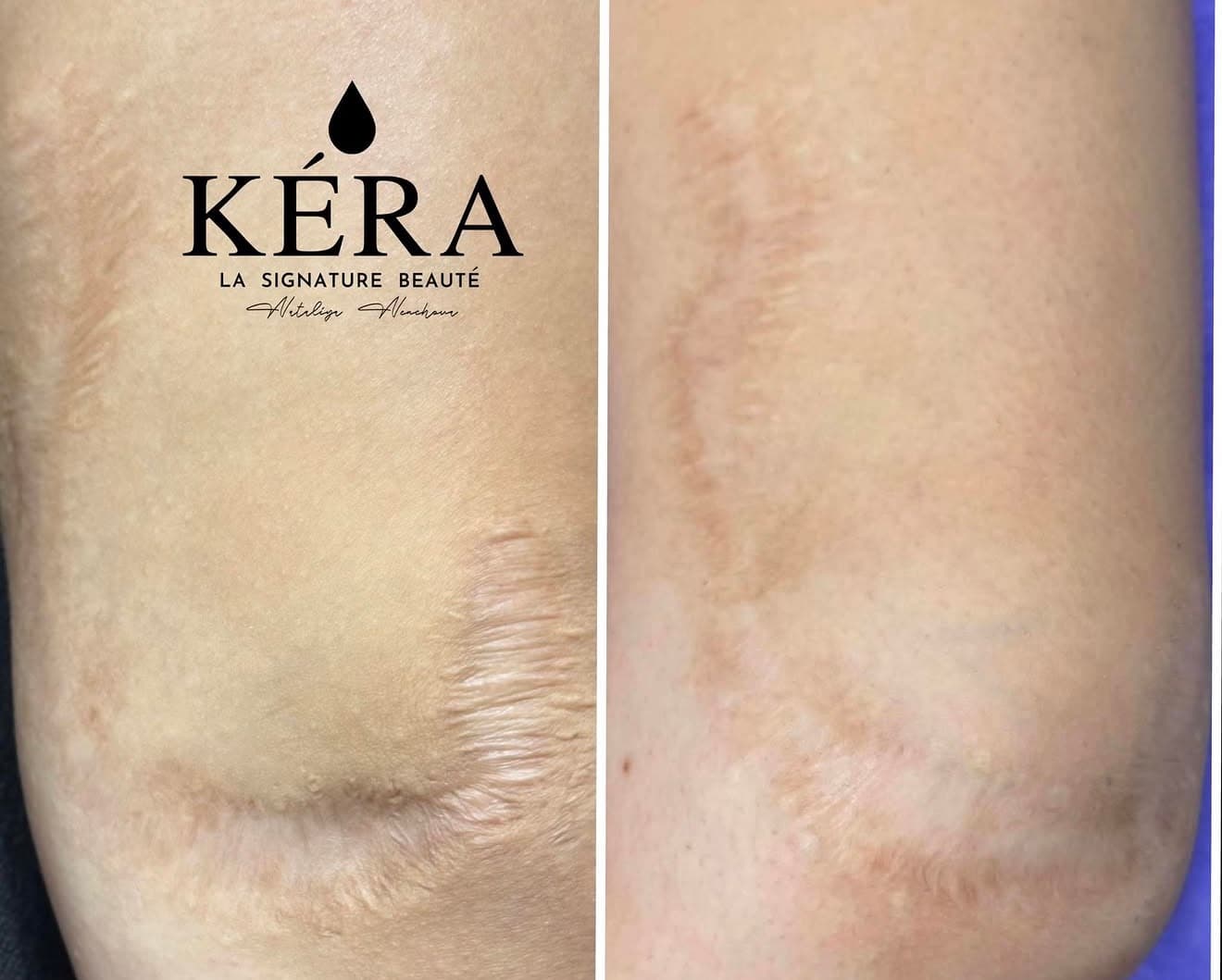 Surgical Scars Aren't Difficult Because They're Visible