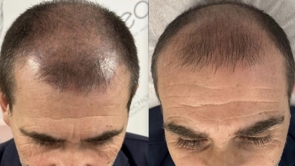 Tricopigmentation transformation