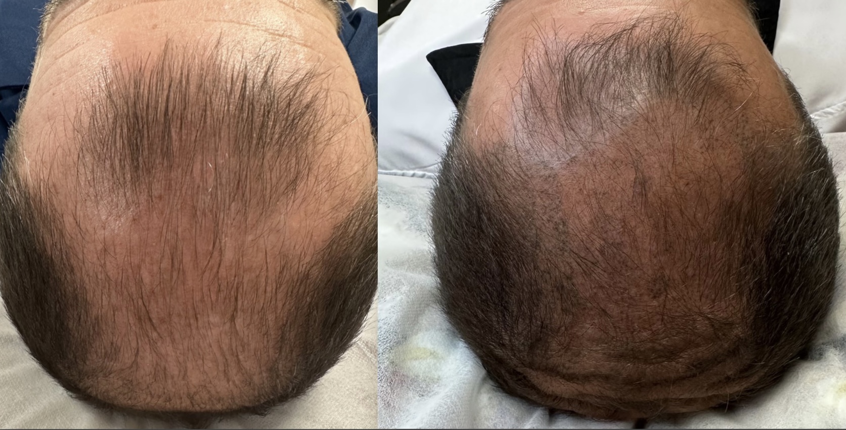 Tricopigmentation transformation